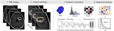 Radiomics in Glioblastoma: Current Status and Challenges Facing Clinical Implementation